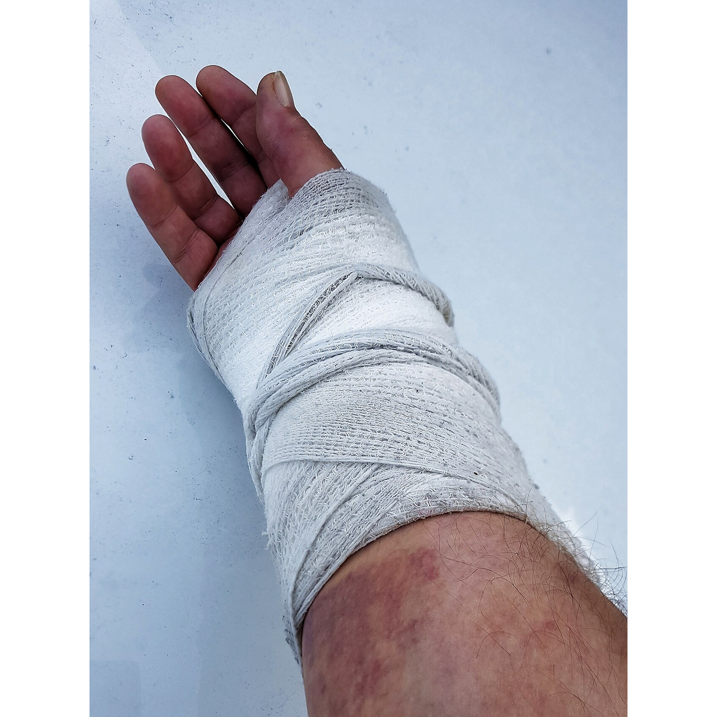 The Plaster Cast: Gypsum That Sets Round a Broken Limb